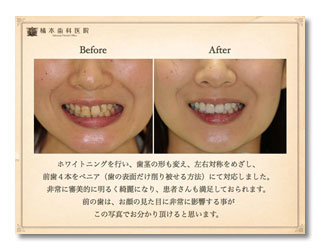 審美修復、歯周形成外科治療の症例
