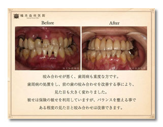 歯周病・咬合補綴2