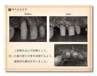歯周病・咬合補綴4