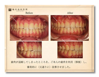 歯周形成外科1