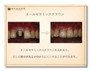 一般歯科（クラウン・歯肉漂白）1