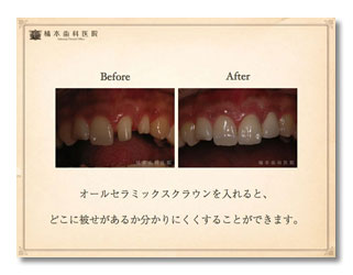 一般歯科（クラウン・歯肉漂白）2