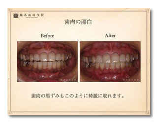 一般歯科（クラウン・歯肉漂白）3