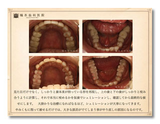 仮歯の重要性3