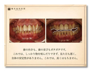 咬合補綴・歯周病・審美　仮歯でのシュミレーション2