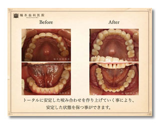 咬合補綴・歯周病・審美　仮歯でのシュミレーション5