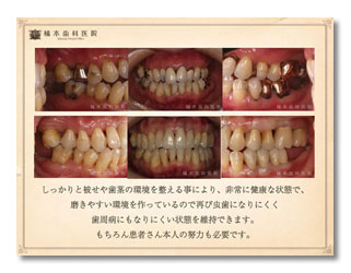 歯周病・審美・咬合補綴1-5