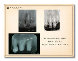 一般歯科（歯内治療）1