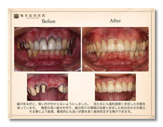 矯正治療、審美修復、歯周形成外科治療の症例（矯正治療は前歯部の部分矯正のみ）